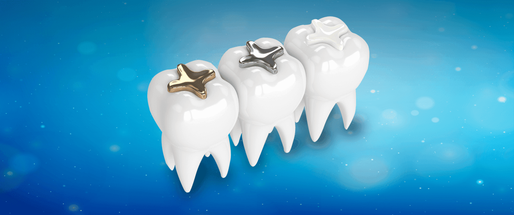 Ästhetische Zahnfüllung - Hospitadent