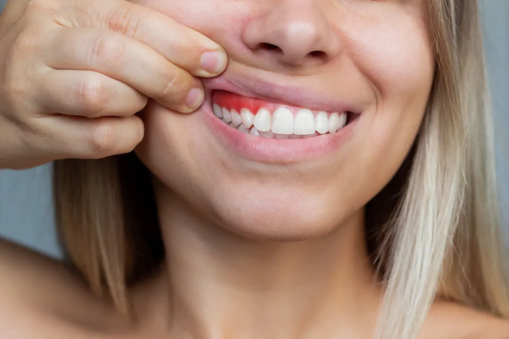 gum recession